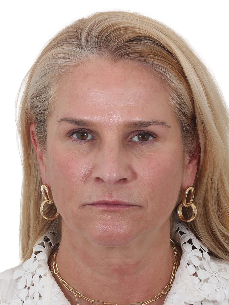 Fat Transfer Before & After Gallery - Patient 151839 - Image 1