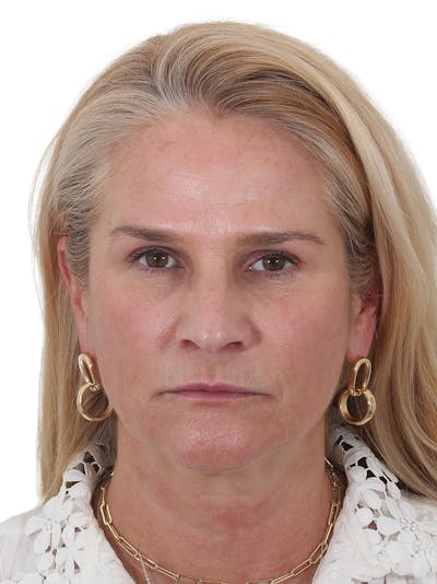 Laser Treatment Before & After Gallery - Patient 276082 - Image 1