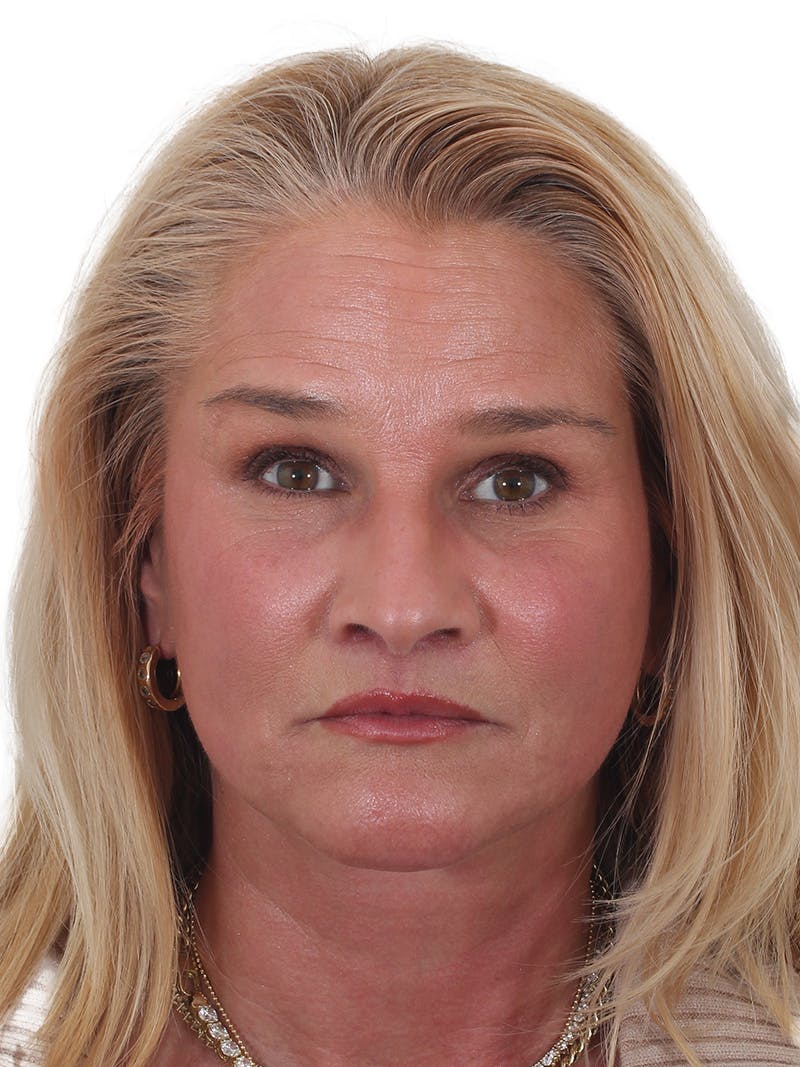 Fat Transfer Before & After Gallery - Patient 151839 - Image 2