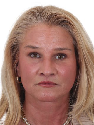 Laser Treatment Before & After Gallery - Patient 276082 - Image 2