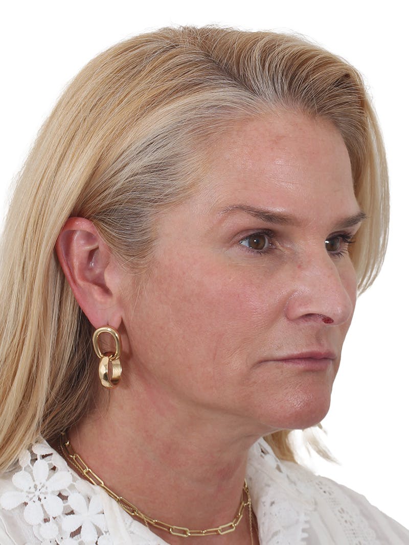 Fat Transfer Before & After Gallery - Patient 151839 - Image 3