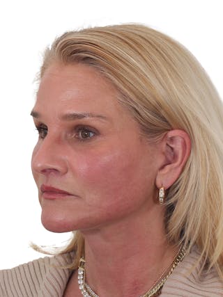 Laser Treatment Before & After Gallery - Patient 276082 - Image 10
