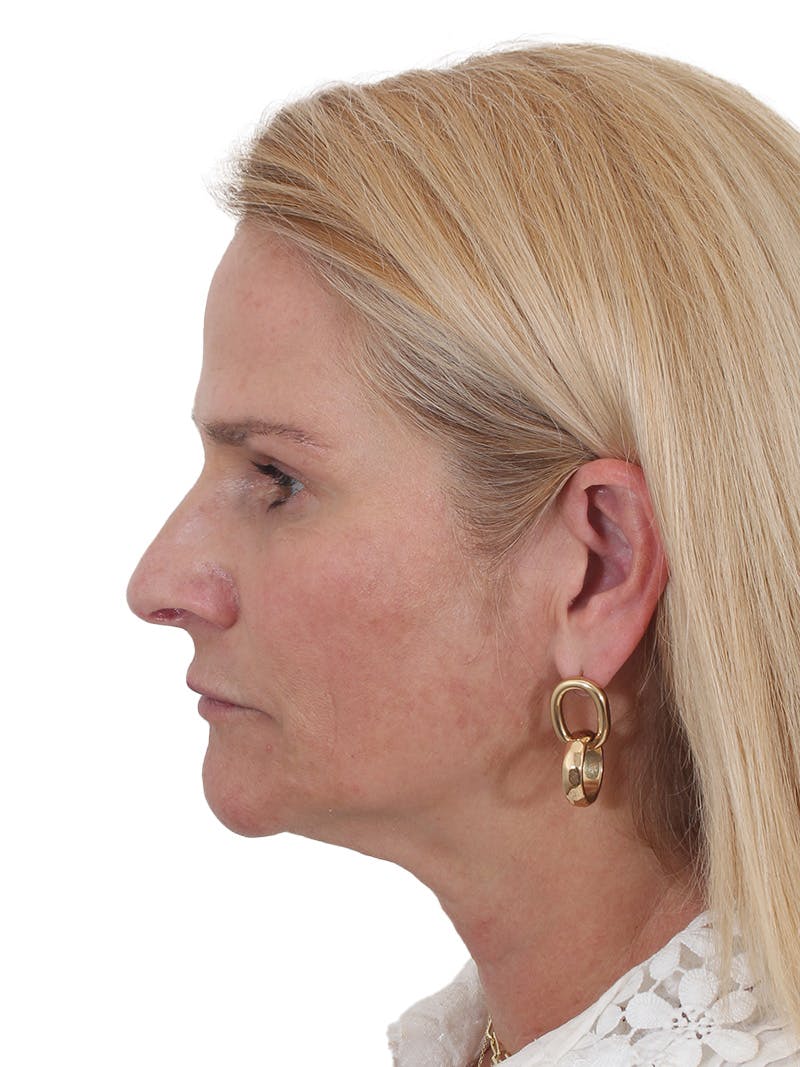 Fat Transfer Before & After Gallery - Patient 151839 - Image 11