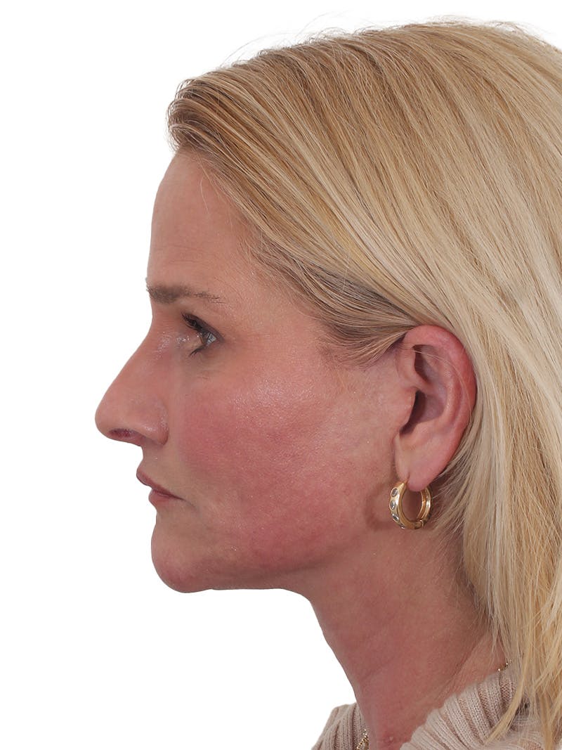 Fat Transfer Before & After Gallery - Patient 151839 - Image 12