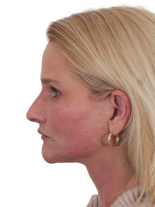 Laser Treatment Before & After Gallery - Patient 276082 - Image 12