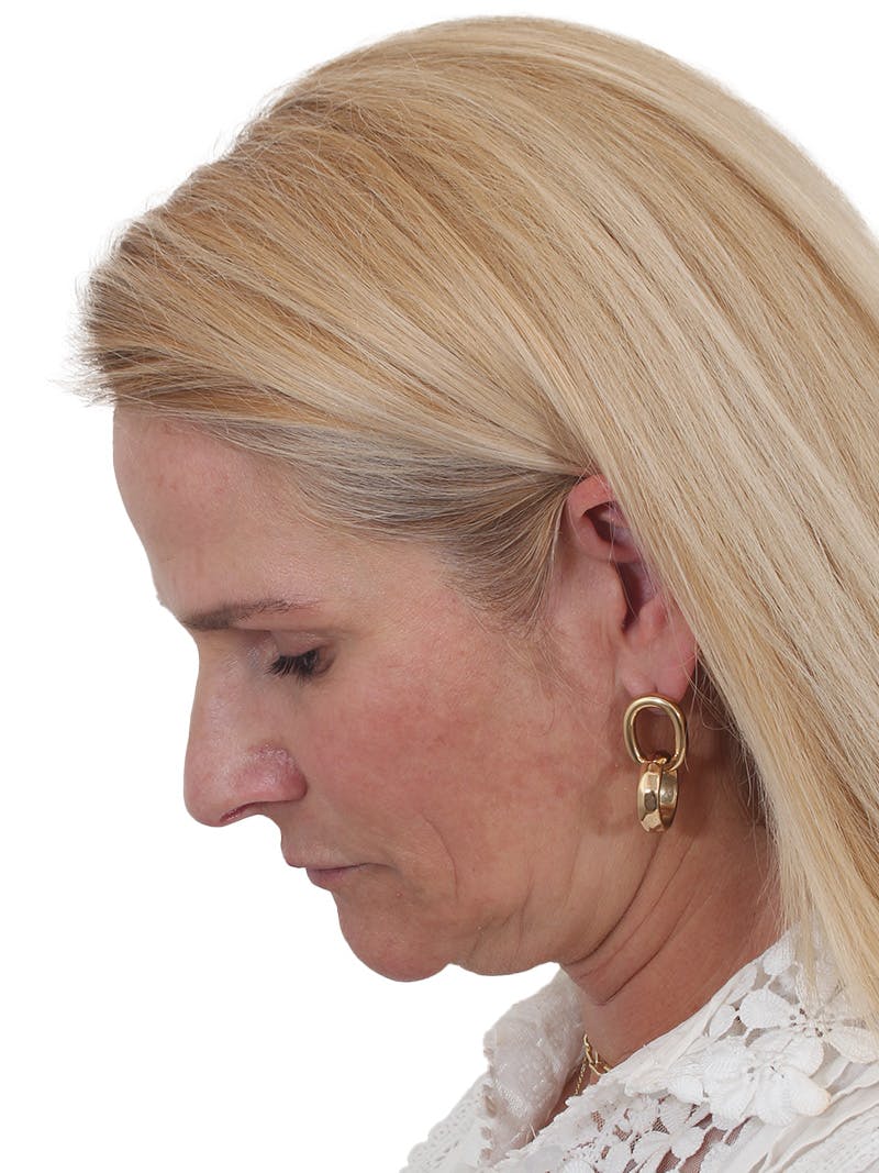 Fat Transfer Before & After Gallery - Patient 151839 - Image 13