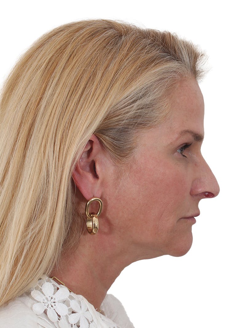 Fat Transfer Before & After Gallery - Patient 151839 - Image 5