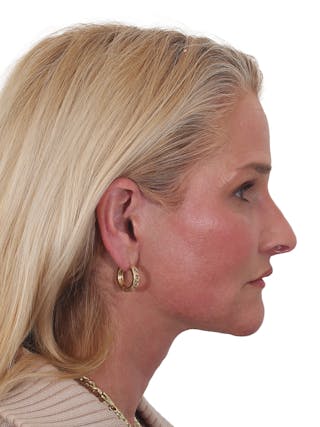 Laser Treatment Before & After Gallery - Patient 276082 - Image 6