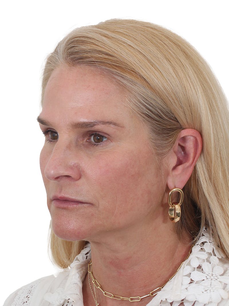 Fat Transfer Before & After Gallery - Patient 151839 - Image 9