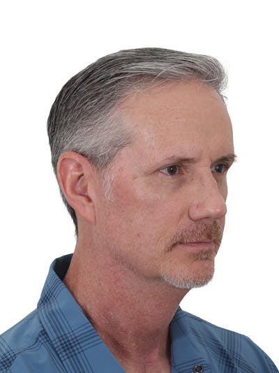 Facelift/Neck Lift Before & After Gallery - Patient 289141 - Image 1