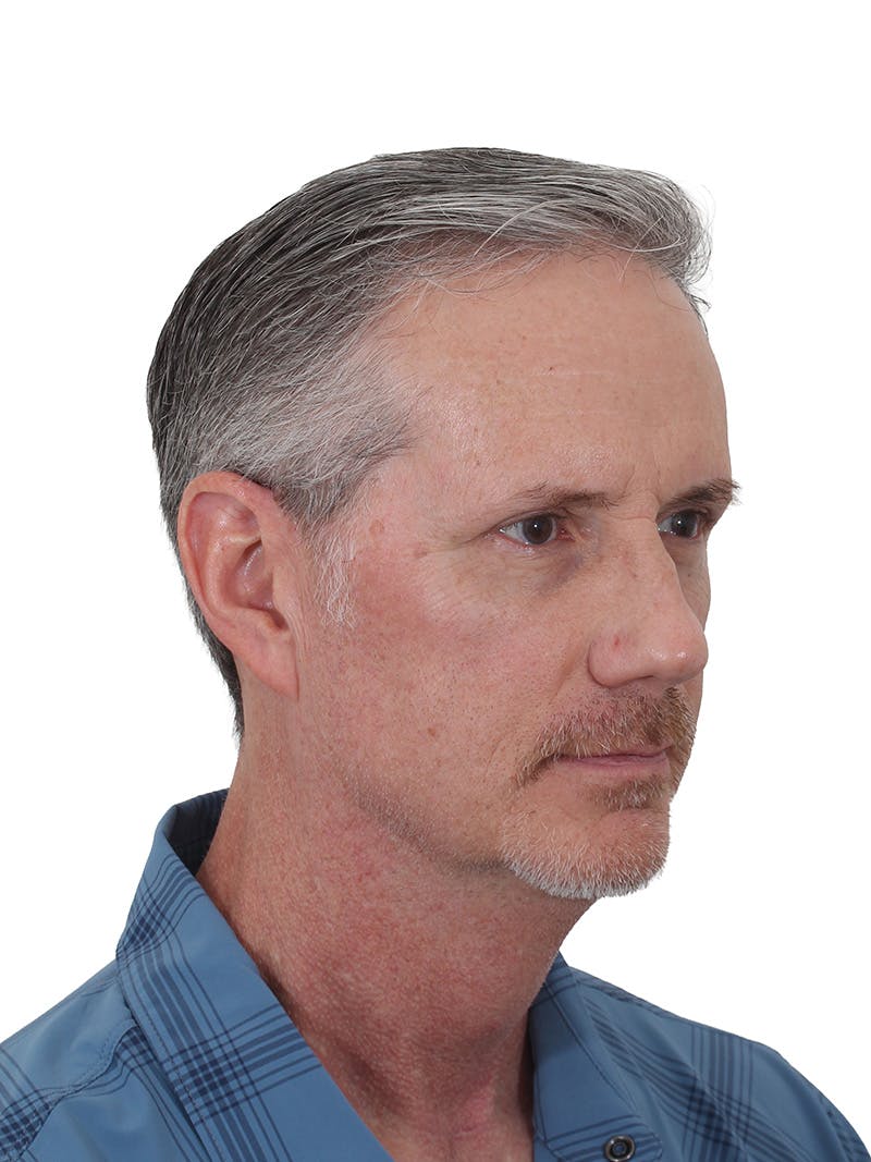 Facelift/Neck Lift Before & After Gallery - Patient 289141 - Image 1