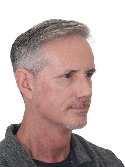 Facelift/Neck Lift Before & After Gallery - Patient 289141 - Image 2
