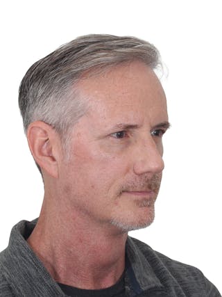Facelift/Neck Lift Before & After Gallery - Patient 289141 - Image 2