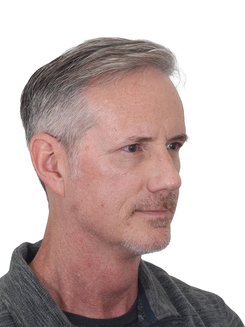 Facelift/Neck Lift Before & After Gallery - Patient 289141 - Image 2