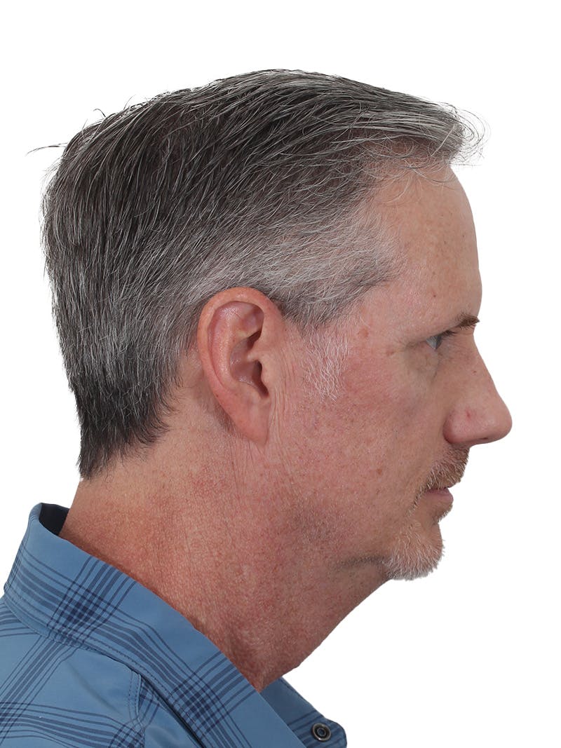 Facelift/Neck Lift Before & After Gallery - Patient 289141 - Image 3