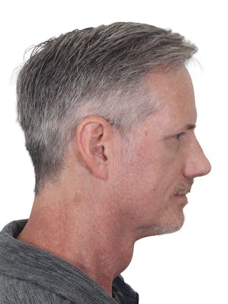 Facelift/Neck Lift Before & After Gallery - Patient 289141 - Image 4