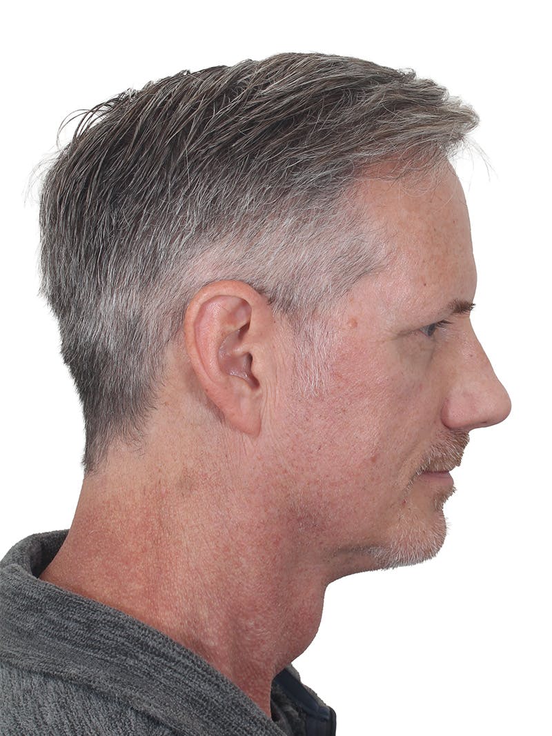 Facelift/Neck Lift Before & After Gallery - Patient 289141 - Image 4