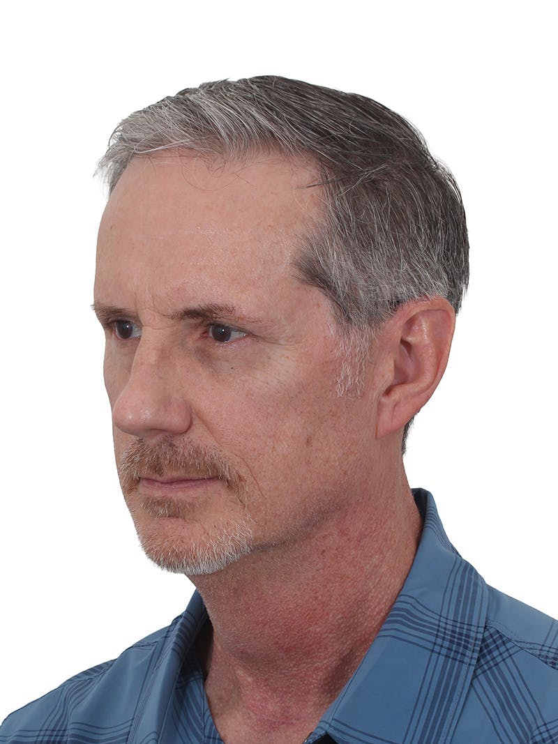 Facelift/Neck Lift Before & After Gallery - Patient 289141 - Image 5