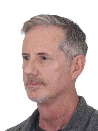 Facelift/Neck Lift Before & After Gallery - Patient 289141 - Image 6