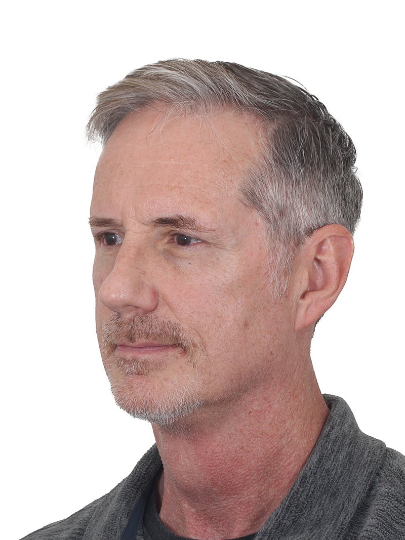 Facelift/Neck Lift Before & After Gallery - Patient 289141 - Image 6