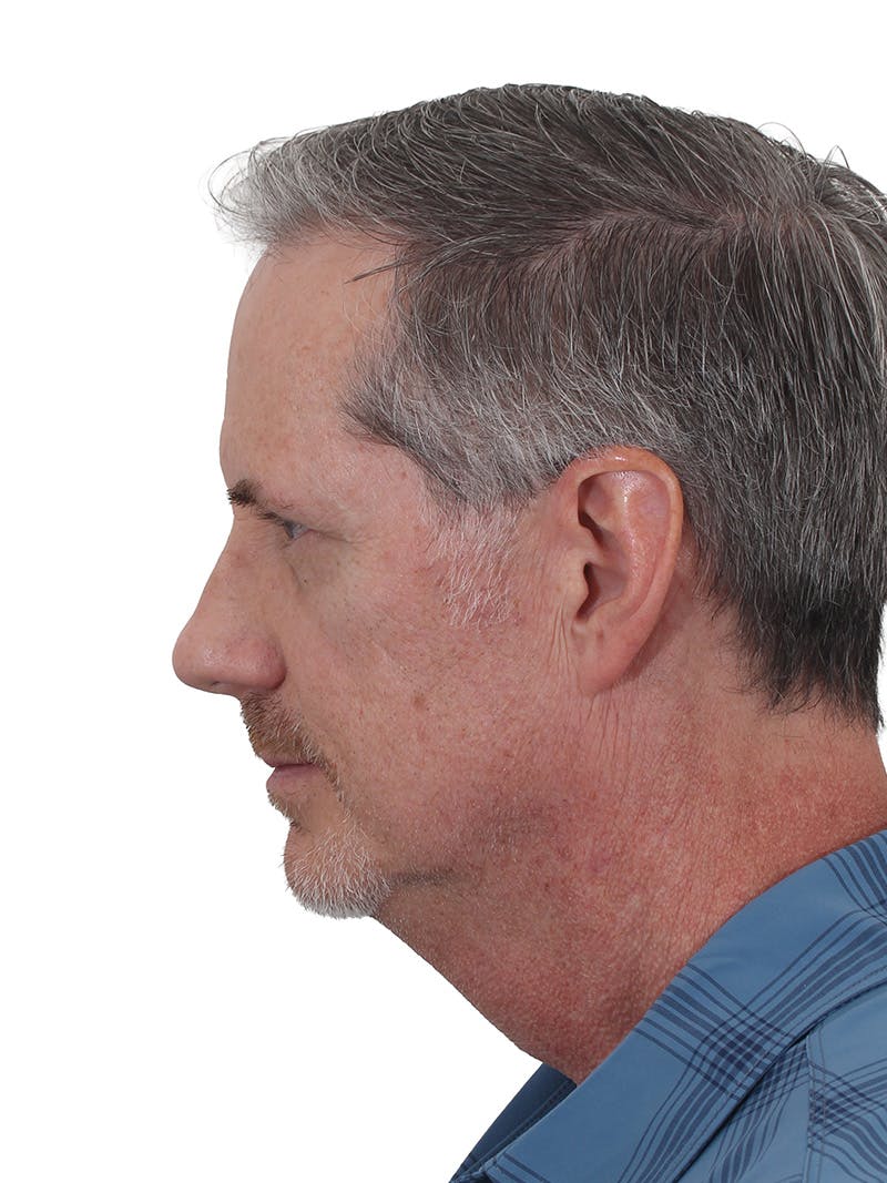 Facelift/Neck Lift Before & After Gallery - Patient 289141 - Image 7