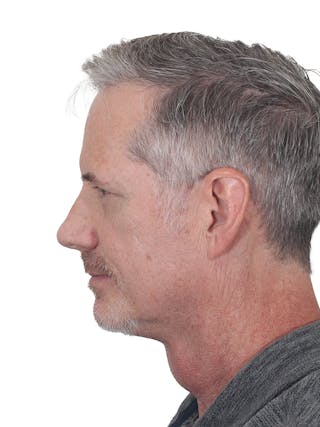 Facelift/Neck Lift Before & After Gallery - Patient 289141 - Image 8