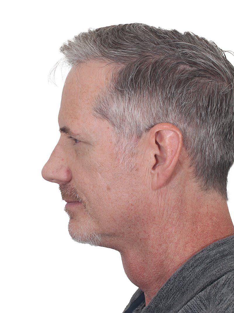 Facelift/Neck Lift Before & After Gallery - Patient 289141 - Image 8