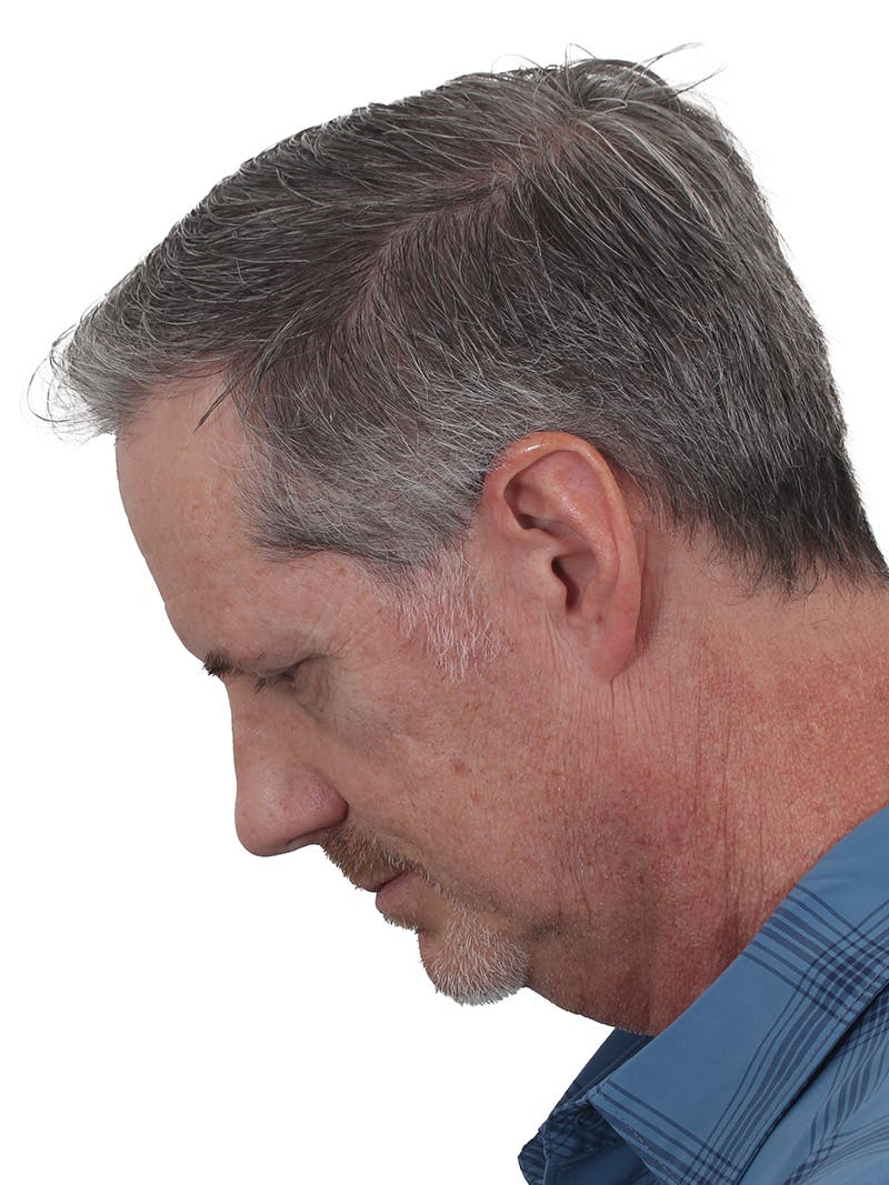 Facelift/Neck Lift Before & After Gallery - Patient 289141 - Image 9