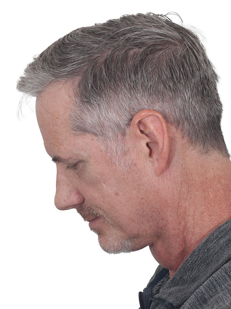 Facelift/Neck Lift Before & After Gallery - Patient 289141 - Image 10