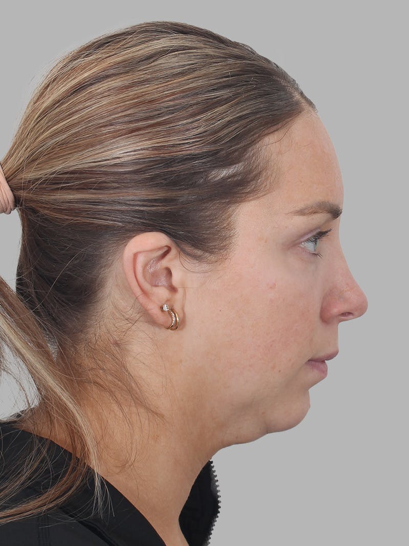 Submental Liposuction Before & After Gallery - Patient 355081 - Image 7