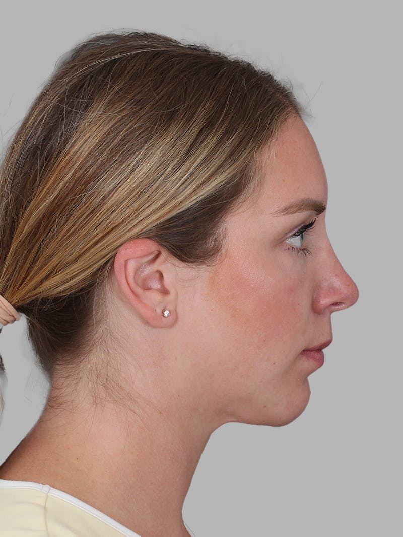 Submental Liposuction Before & After Gallery - Patient 355081 - Image 8