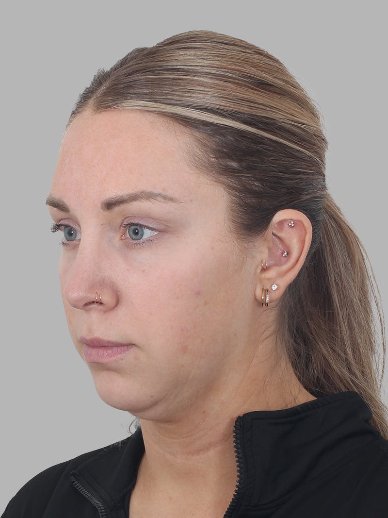 Submental Liposuction Before & After Gallery - Patient 355081 - Image 5