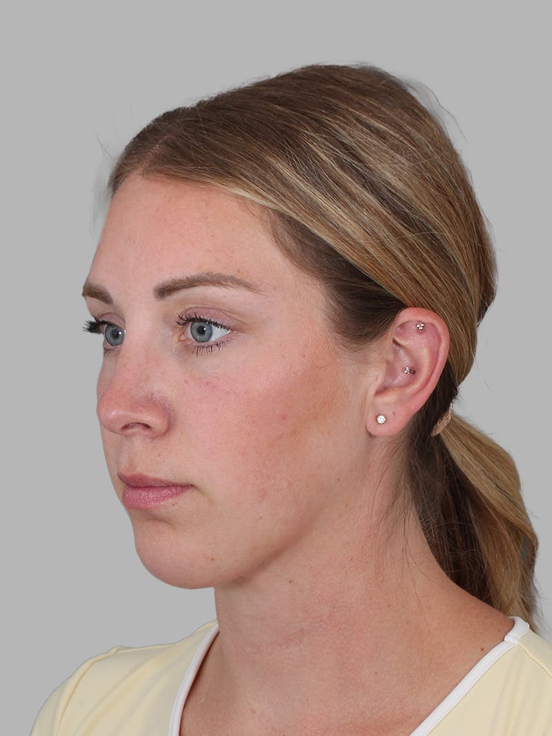 Submental Liposuction Before & After Gallery - Patient 355081 - Image 6