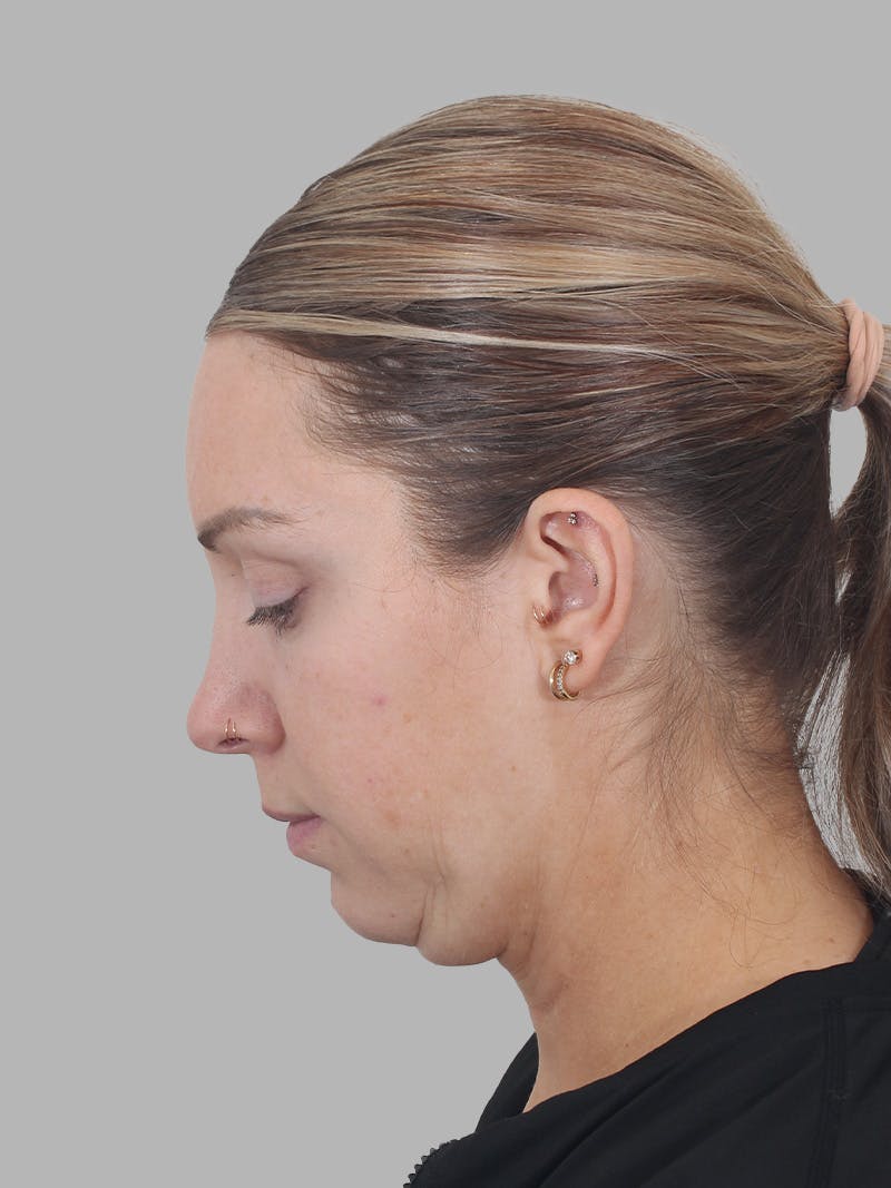Submental Liposuction Before & After Gallery - Patient 355081 - Image 3