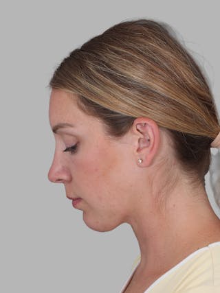 Submental Liposuction Before & After Gallery - Patient 355081 - Image 4