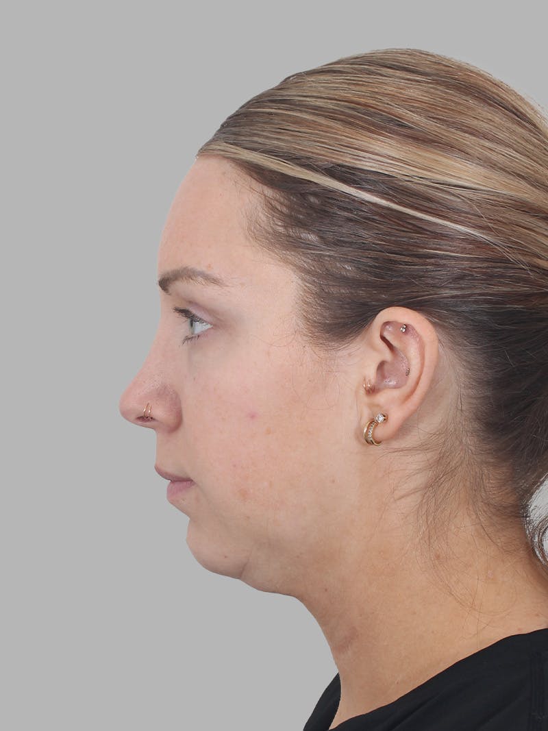 Submental Liposuction Before & After Gallery - Patient 355081 - Image 1