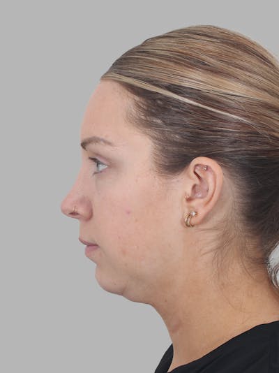 Submental Liposuction Before & After Gallery - Patient 355081 - Image 1