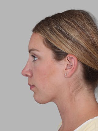 Submental Liposuction Before & After Gallery - Patient 355081 - Image 2
