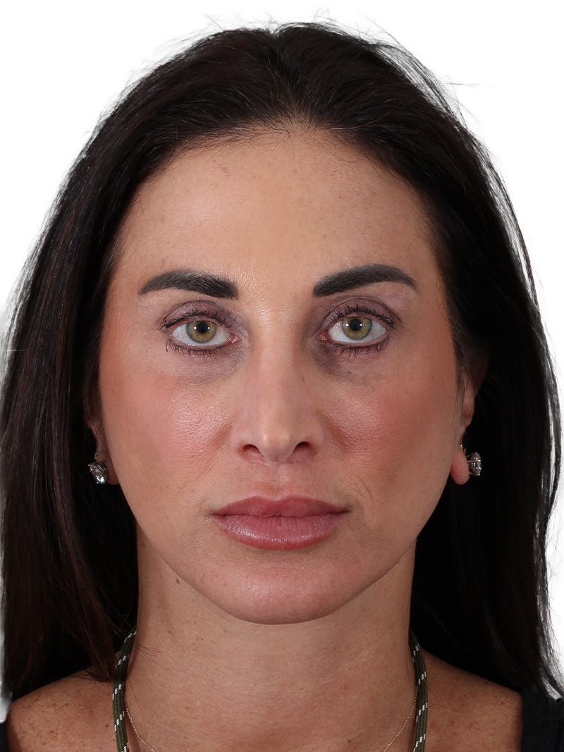 Facelift/Neck Lift Before & After Gallery - Patient 215029 - Image 4