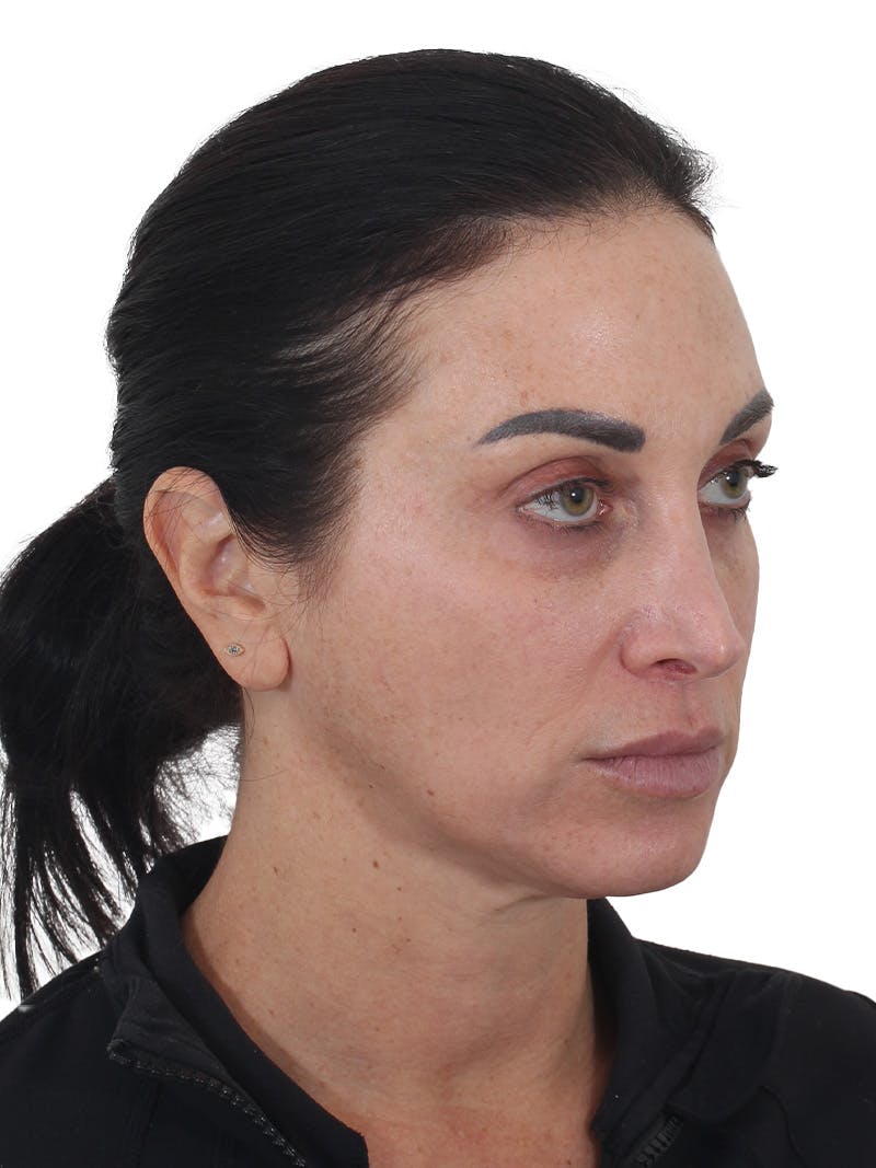 Facelift/Neck Lift Before & After Gallery - Patient 215029 - Image 5