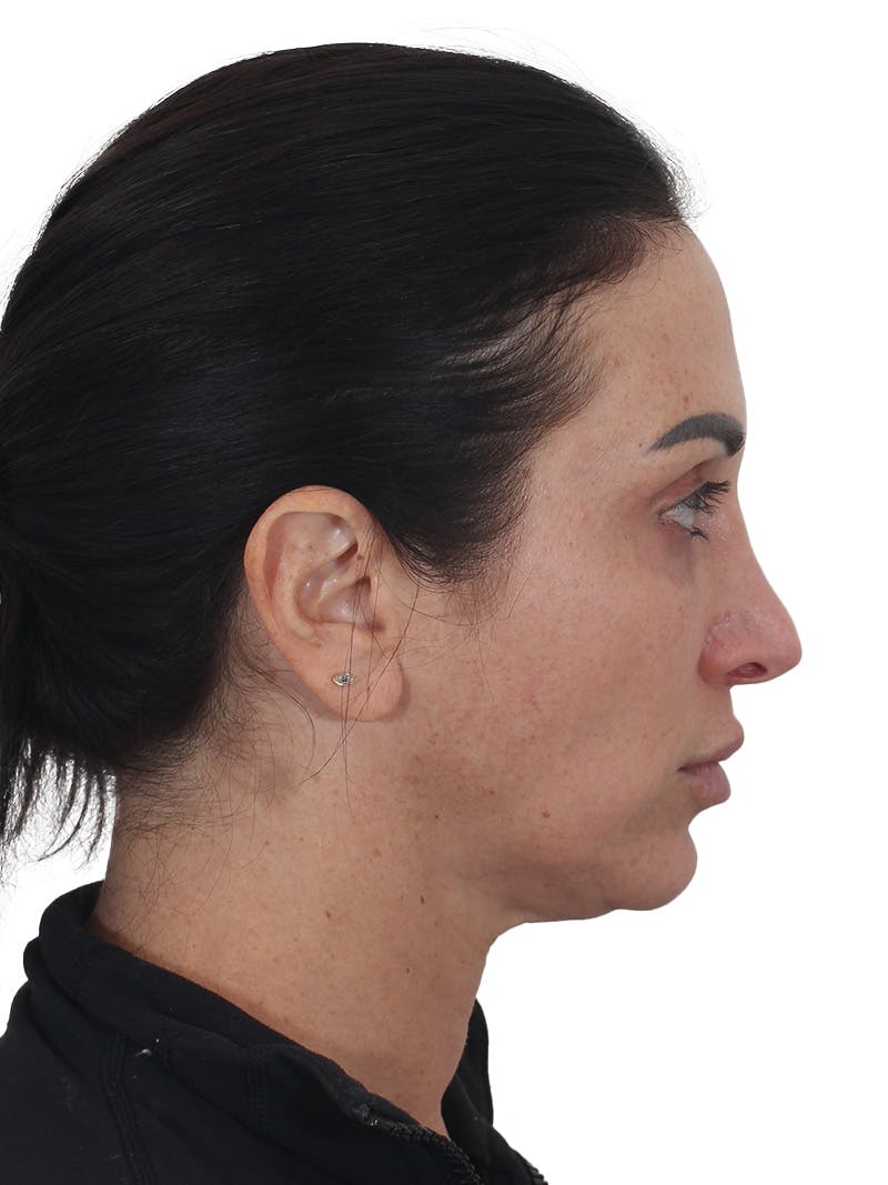 Facelift/Neck Lift Before & After Gallery - Patient 215029 - Image 7