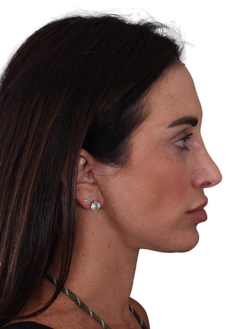 Facelift/Neck Lift Before & After Gallery - Patient 215029 - Image 8
