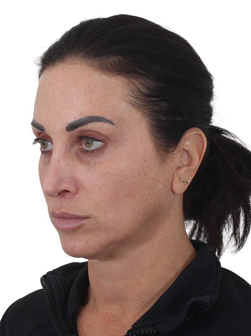 Facelift/Neck Lift Before & After Gallery - Patient 215029 - Image 1