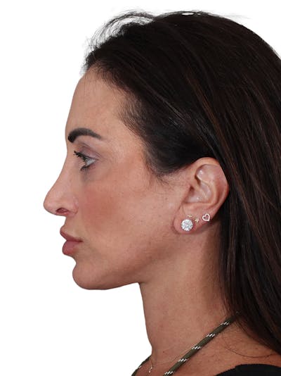 Facelift/Neck Lift Before & After Gallery - Patient 215029 - Image 2