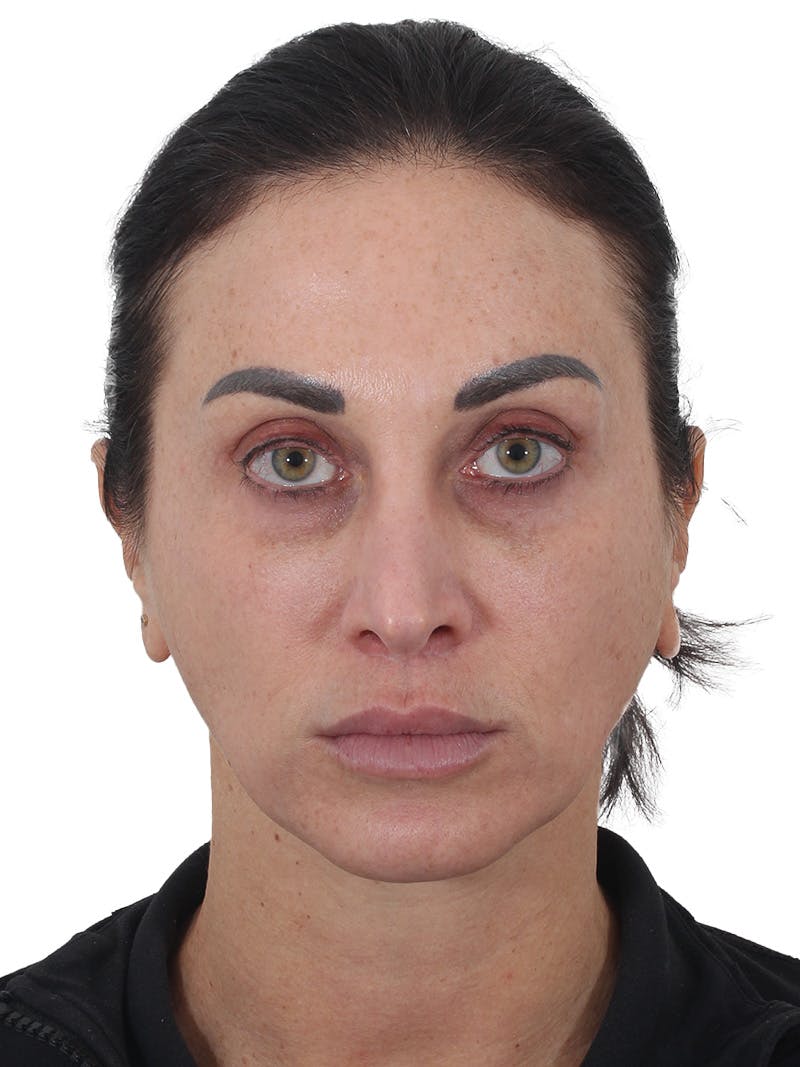 Facelift/Neck Lift Before & After Gallery - Patient 215029 - Image 3