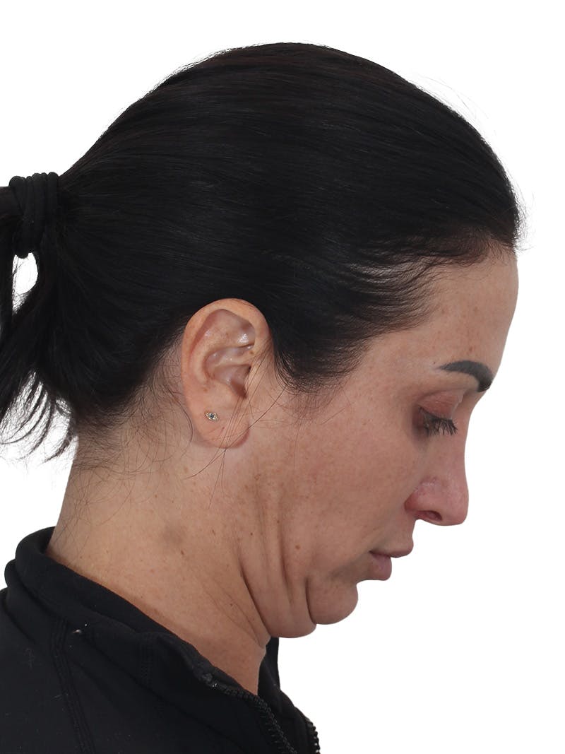 Facelift/Neck Lift Before & After Gallery - Patient 215029 - Image 9