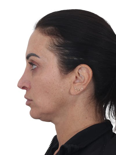 Facelift/Neck Lift Before & After Gallery - Patient 215029 - Image 1