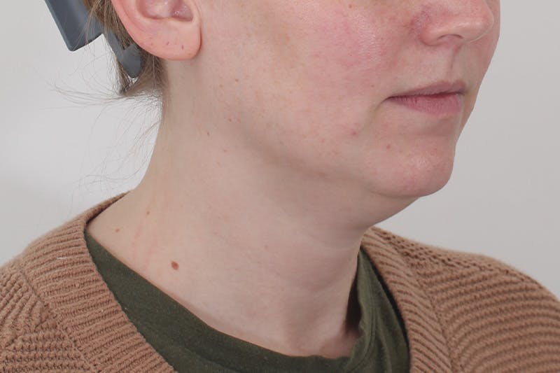 Submental Liposuction Before & After Gallery - Patient 831565 - Image 5