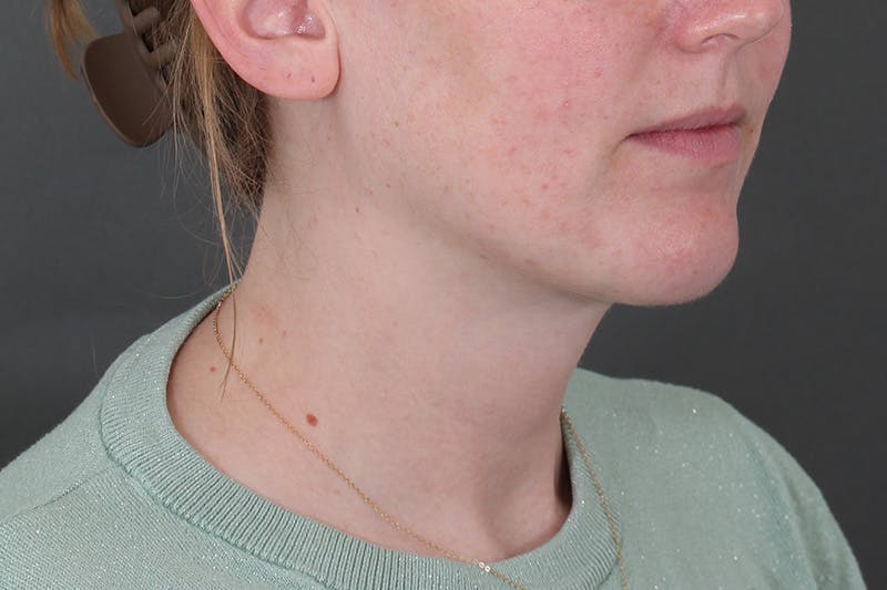 Submental Liposuction Before & After Gallery - Patient 831565 - Image 6