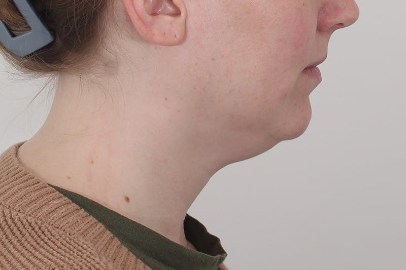Submental Liposuction Before & After Gallery - Patient 831565 - Image 7